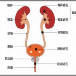 腎臓結石、尿管結石、尿路結石の違いは何？検査方法や治療法は？